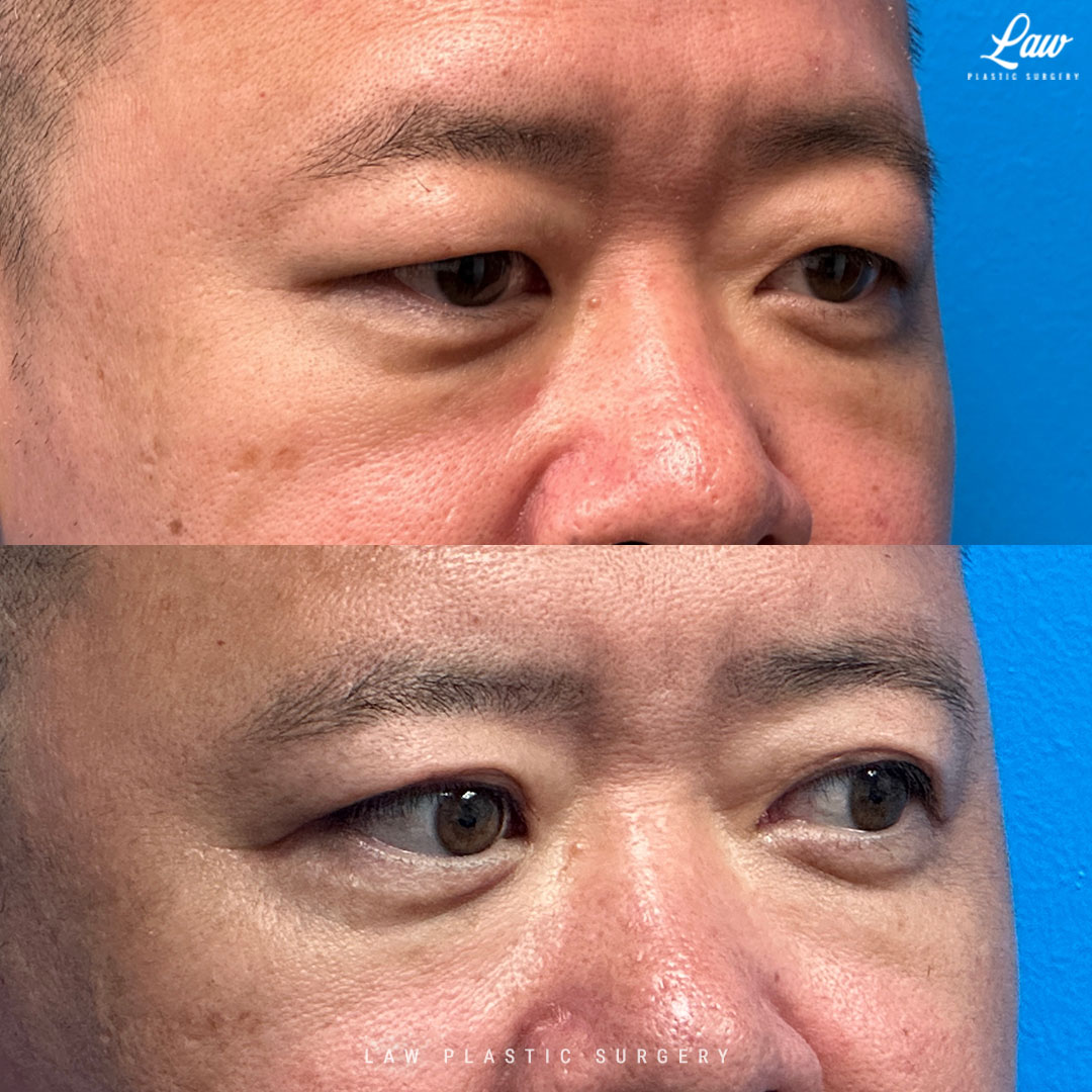 Asian Eyelid Surgery Before & After Photo. Surgery performed in Dallas, TX at Law Plastic Surgery.