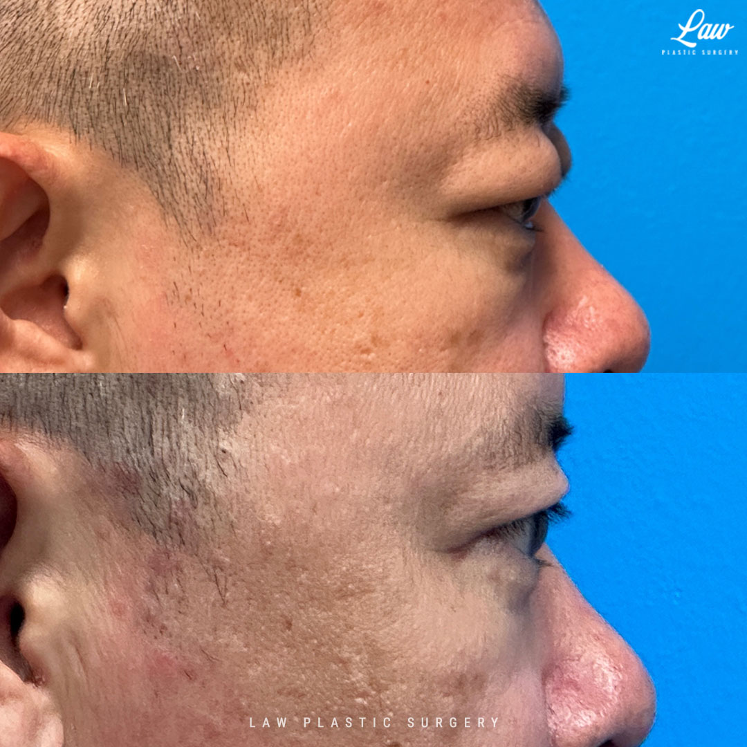 Asian Eyelid Surgery Before & After Photo. Surgery performed in Dallas, TX at Law Plastic Surgery.