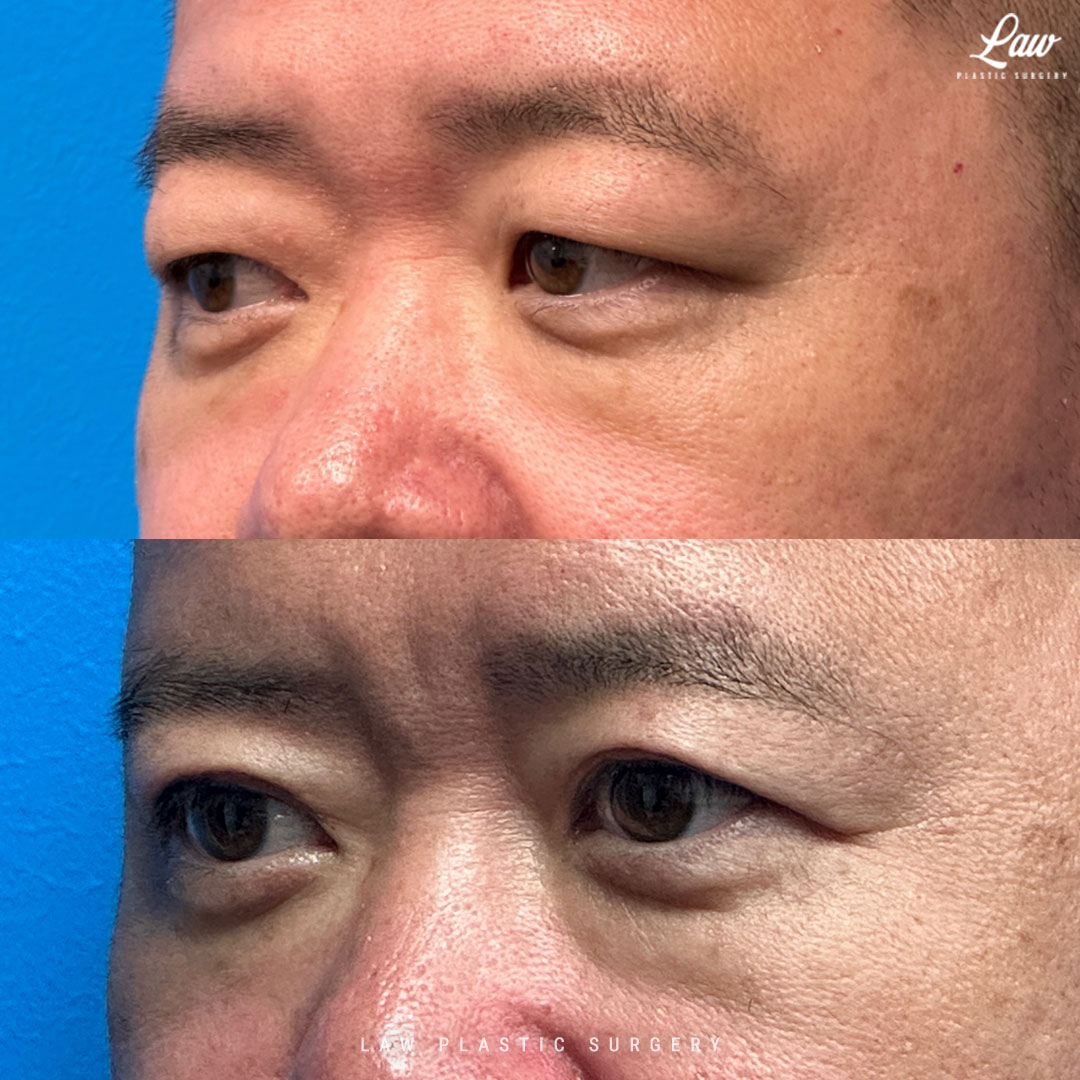 Asian Eyelid Surgery Before & After Photo. Surgery performed in Dallas, TX at Law Plastic Surgery.