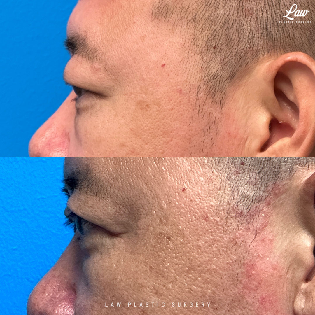 Asian Eyelid Surgery Before & After Photo. Surgery performed in Dallas, TX at Law Plastic Surgery.