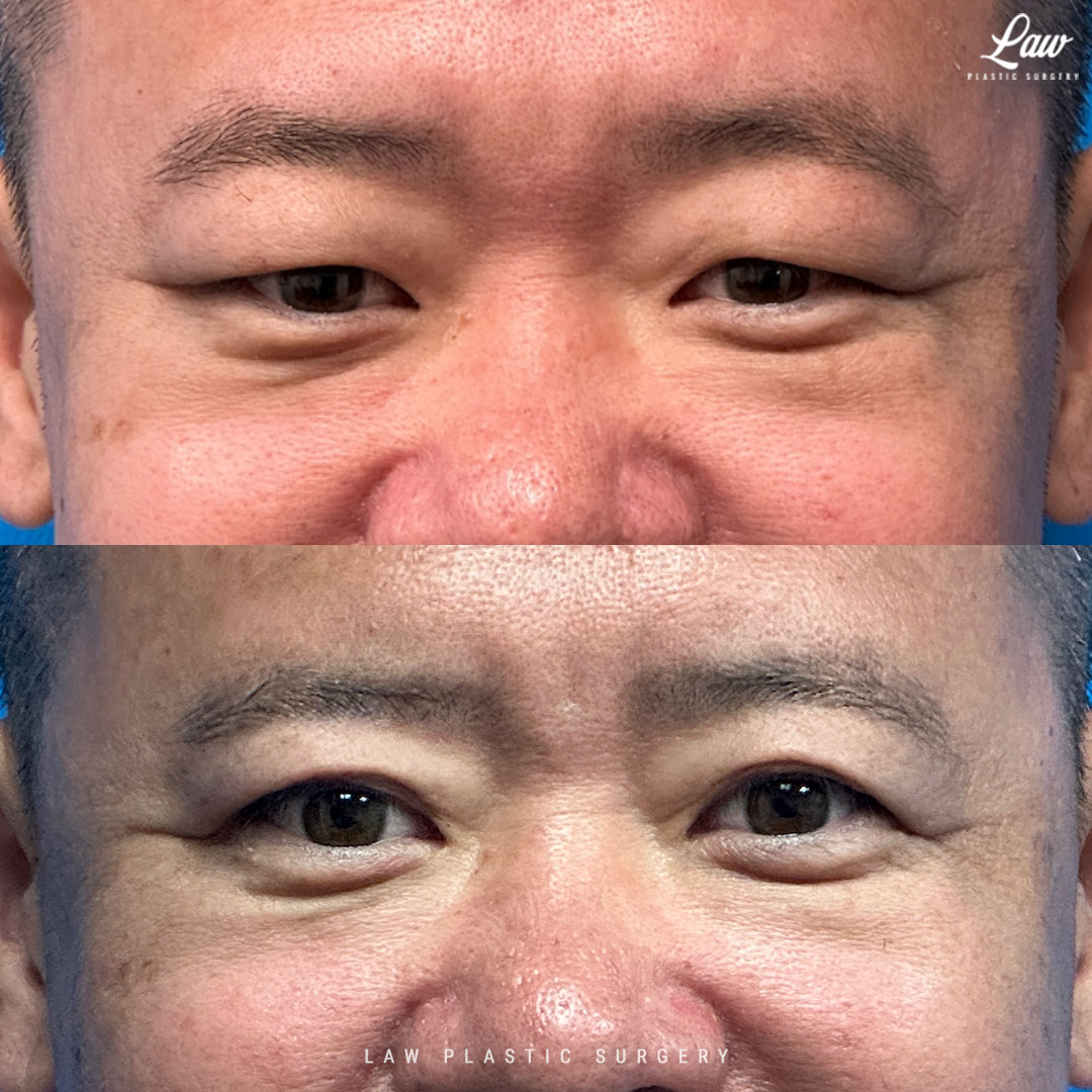 Asian Eyelid Surgery Before & After Photo. Surgery performed in Dallas, TX at Law Plastic Surgery.