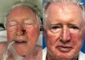 Skin Cancer Reconstruction Before and After Photo. Surgery performed in Dallas, TX at Law Plastic Surgery.