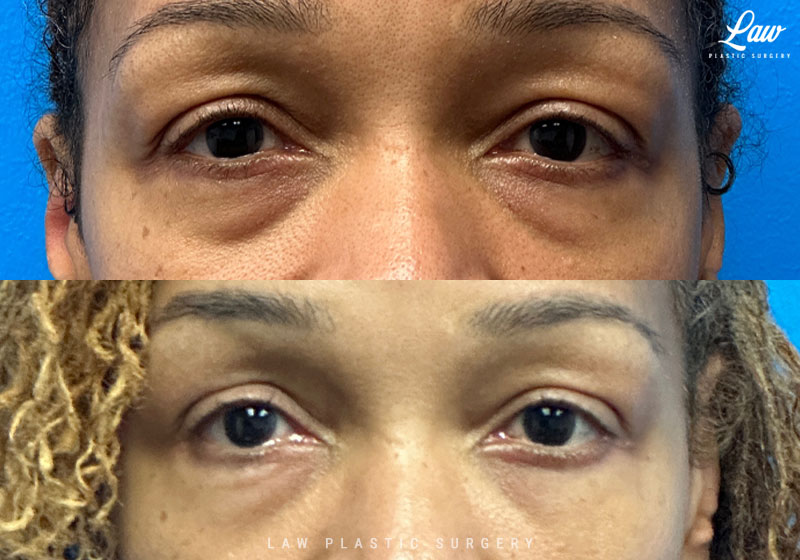 Eyelid Surgery (Blepharoplasty) Before & After Photo. Surgery performed in Dallas, TX at Law Plastic Surgery.