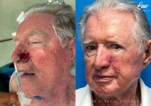 Skin Cancer Reconstruction Before and After Photo. Surgery performed in Dallas, TX at Law Plastic Surgery.