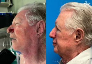 Skin Cancer Reconstruction Before and After Photo. Surgery performed in Dallas, TX at Law Plastic Surgery.