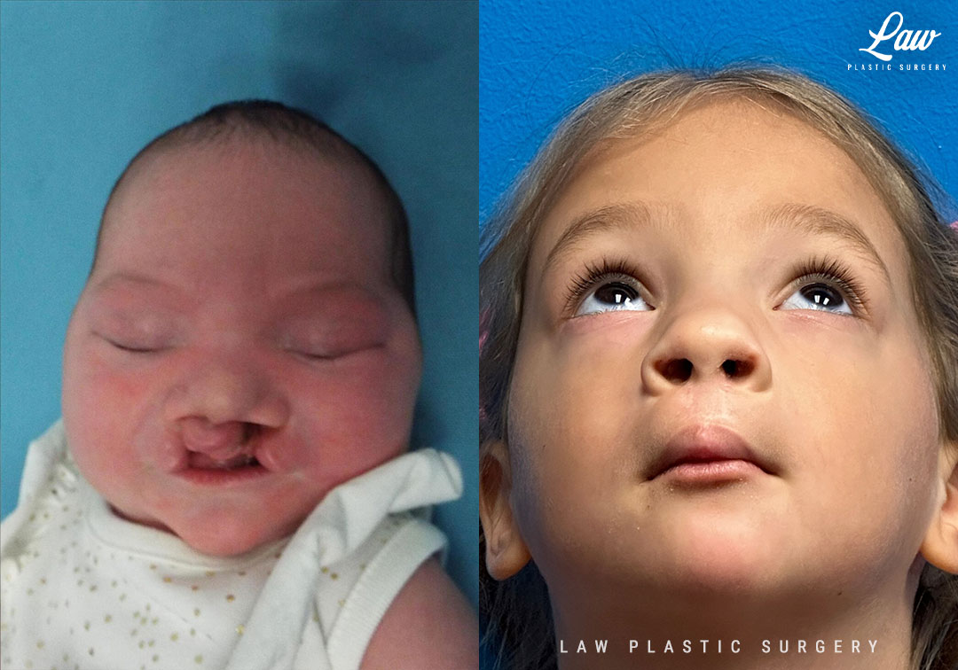 Cleft Lip Repair Before & After Photo. Surgery performed in Dallas, TX at Law Plastic Surgery.