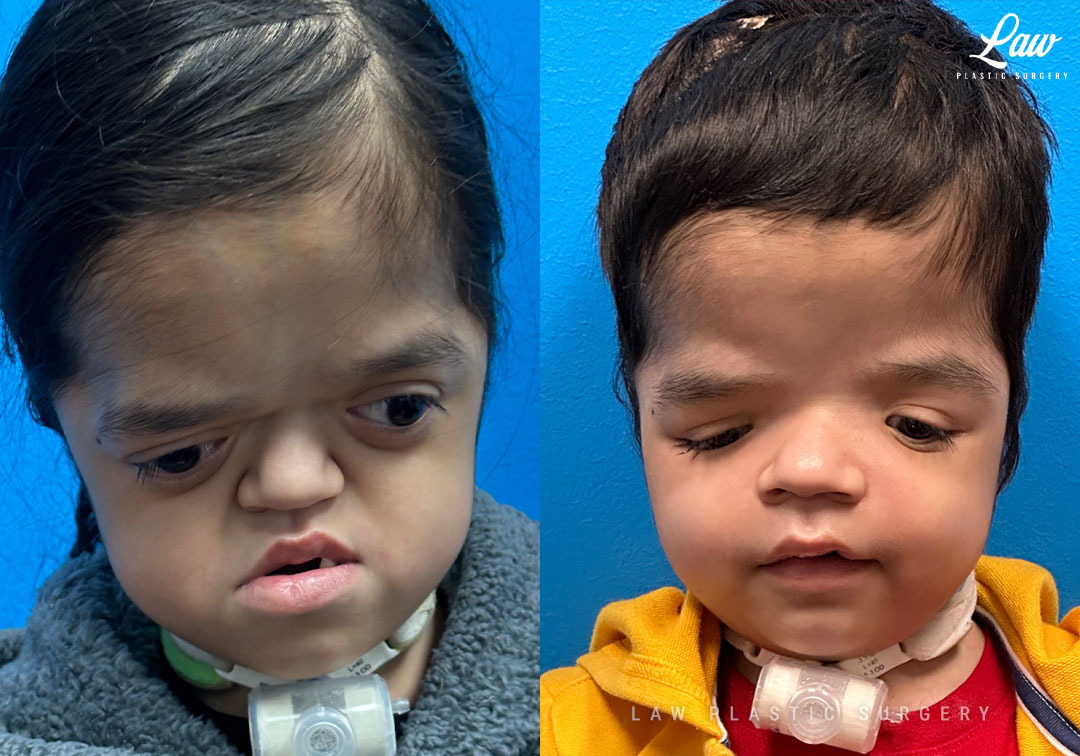 Craniofacial Reconstruction Before & After Photo. Surgery performed in Dallas, TX at Law Plastic Surgery.