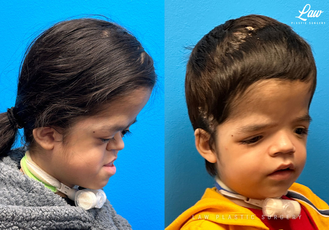 Craniofacial Reconstruction Before & After Photo. Surgery performed in Dallas, TX at Law Plastic Surgery.