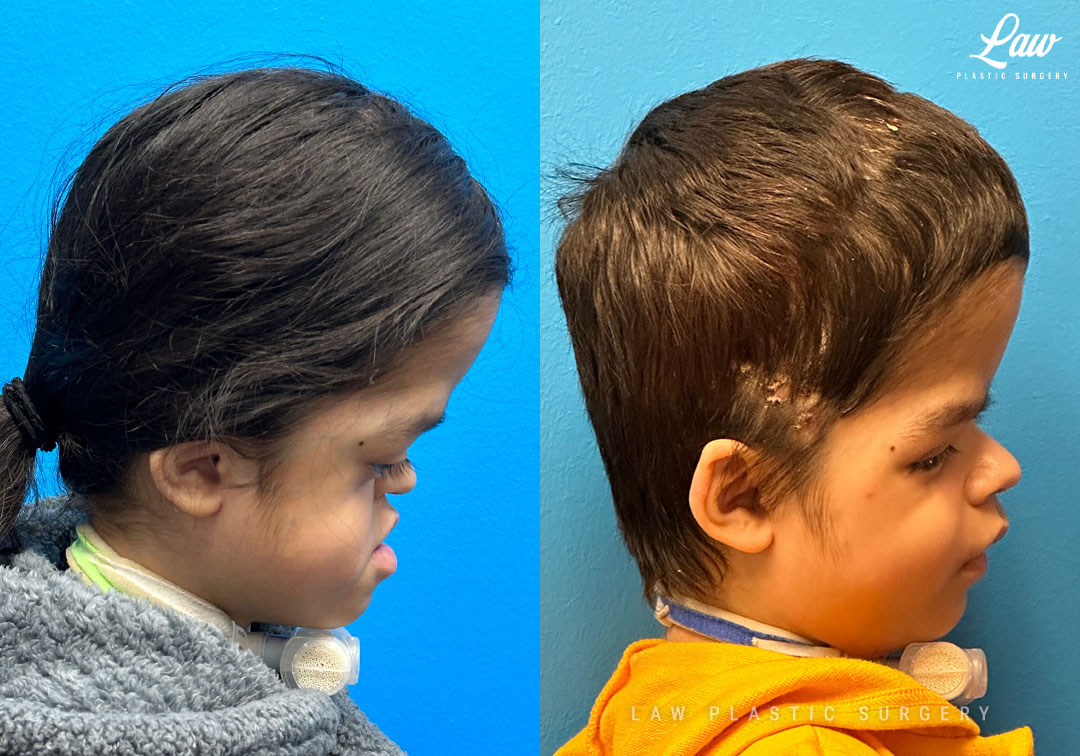 Craniofacial Reconstruction Before & After Photo. Surgery performed in Dallas, TX at Law Plastic Surgery.