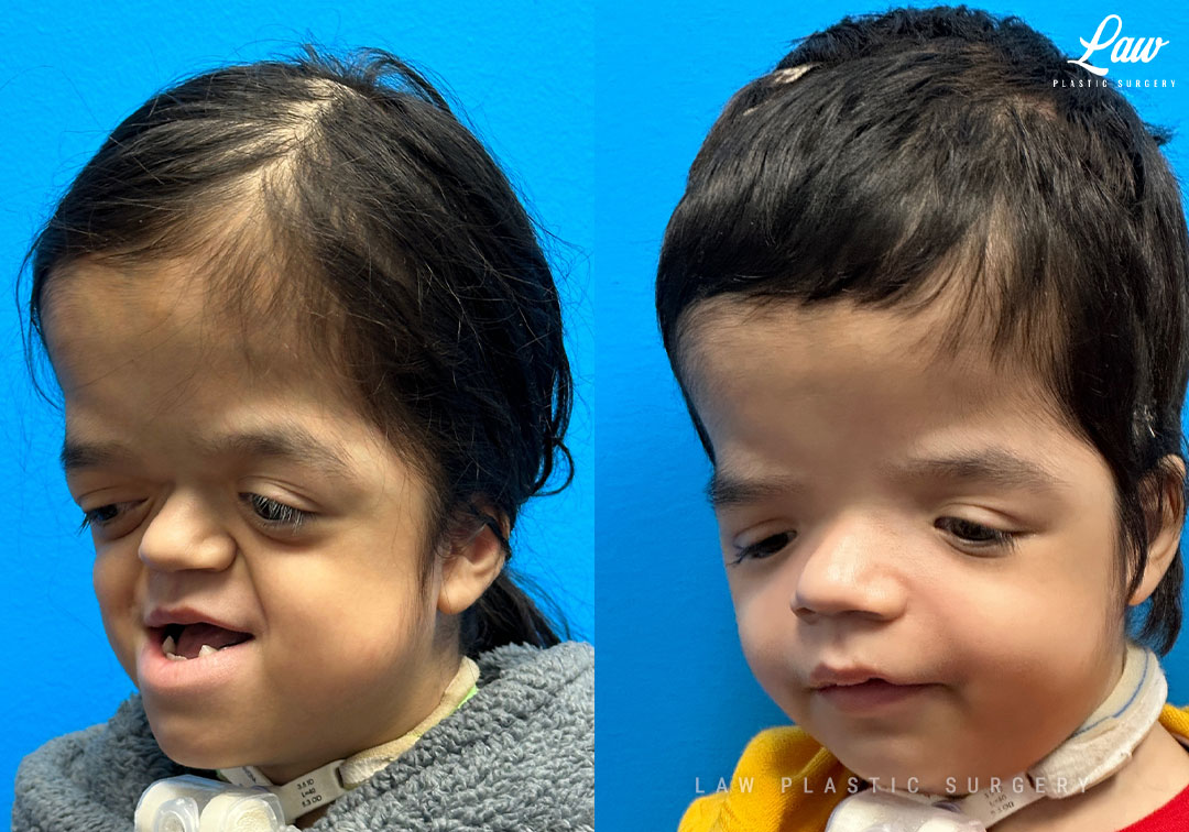 Craniofacial Reconstruction Before & After Photo. Surgery performed in Dallas, TX at Law Plastic Surgery.