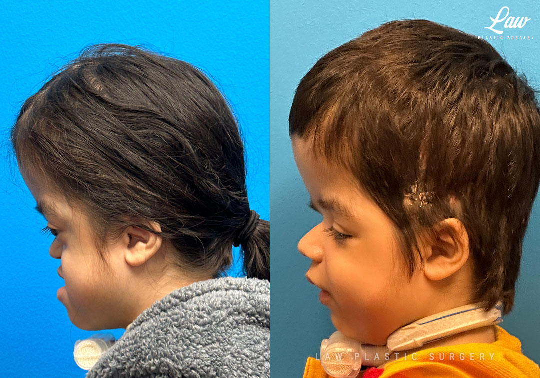 Craniofacial Reconstruction Before & After Photo. Surgery performed in Dallas, TX at Law Plastic Surgery.