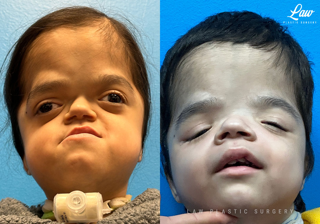 Craniofacial Reconstruction Before & After Photo. Surgery performed in Dallas, TX at Law Plastic Surgery.
