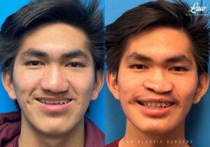 Jaw Surgery Before and After Photo. Surgery performed in Dallas, TX at Law Plastic Surgery.