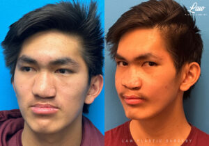 Jaw Surgery Before and After Photo. Surgery performed in Dallas, TX at Law Plastic Surgery.