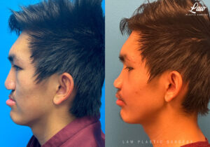 Jaw Surgery Before and After Photo. Surgery performed in Dallas, TX at Law Plastic Surgery.