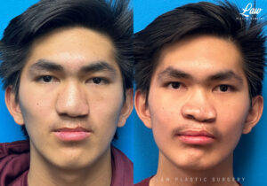 Jaw Surgery Before and After Photo. Surgery performed in Dallas, TX at Law Plastic Surgery.