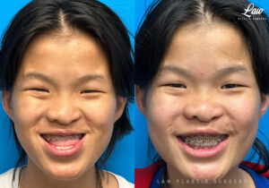 Jaw Surgery Before and After Photo. Surgery performed in Dallas, TX at Law Plastic Surgery.