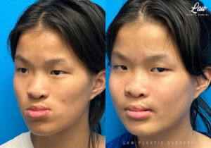 Jaw Surgery Before and After Photo. Surgery performed in Dallas, TX at Law Plastic Surgery.