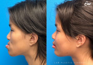 Jaw Surgery Before and After Photo. Surgery performed in Dallas, TX at Law Plastic Surgery.