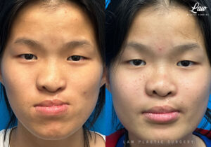 Jaw Surgery Before and After Photo. Surgery performed in Dallas, TX at Law Plastic Surgery.