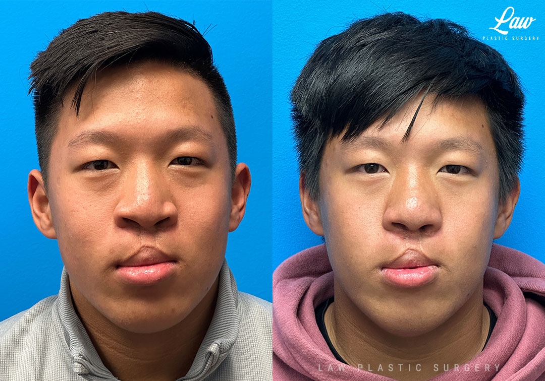 Asian Rhinoplasty Before & After Photo. Surgery performed in Dallas, TX at Law Plastic Surgery.