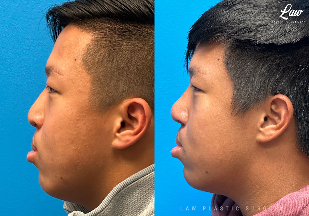 Asian Rhinoplasty Before & After Photo. Surgery performed in Dallas, TX at Law Plastic Surgery.