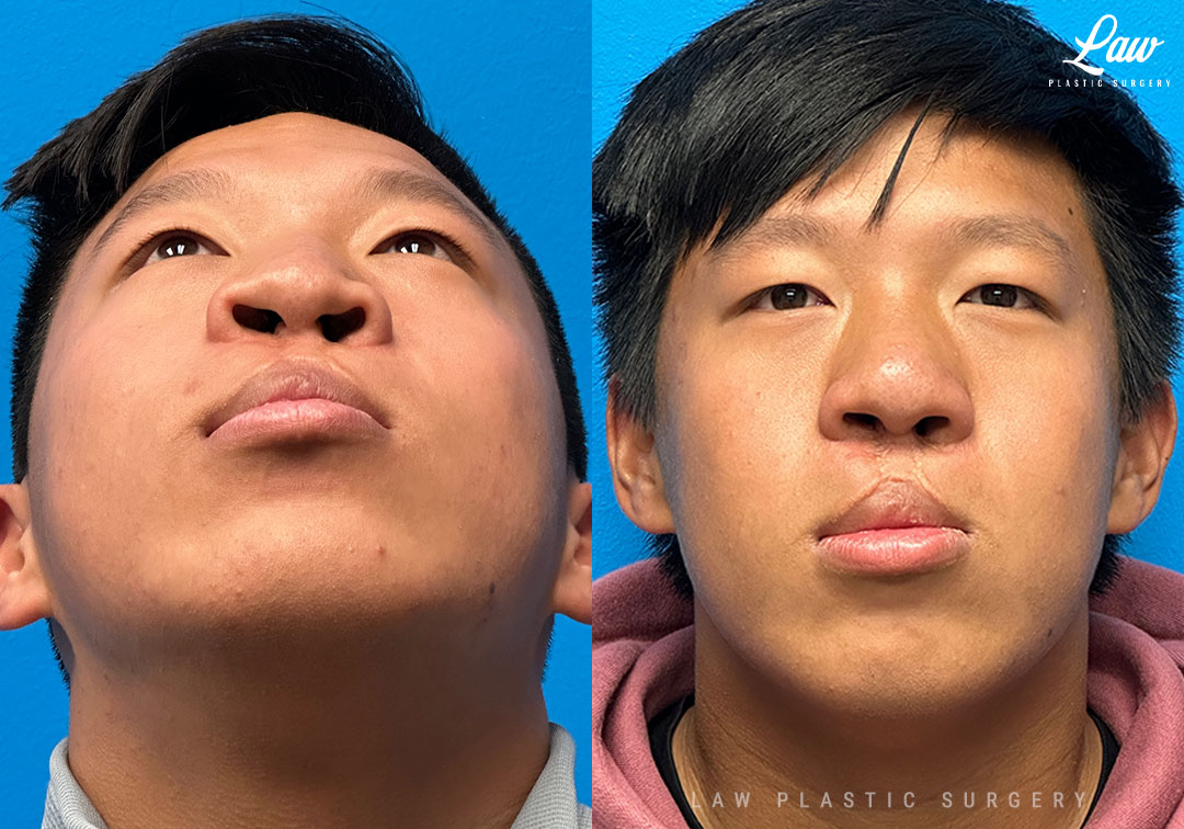 Asian Rhinoplasty Before & After Photo. Surgery performed in Dallas, TX at Law Plastic Surgery.