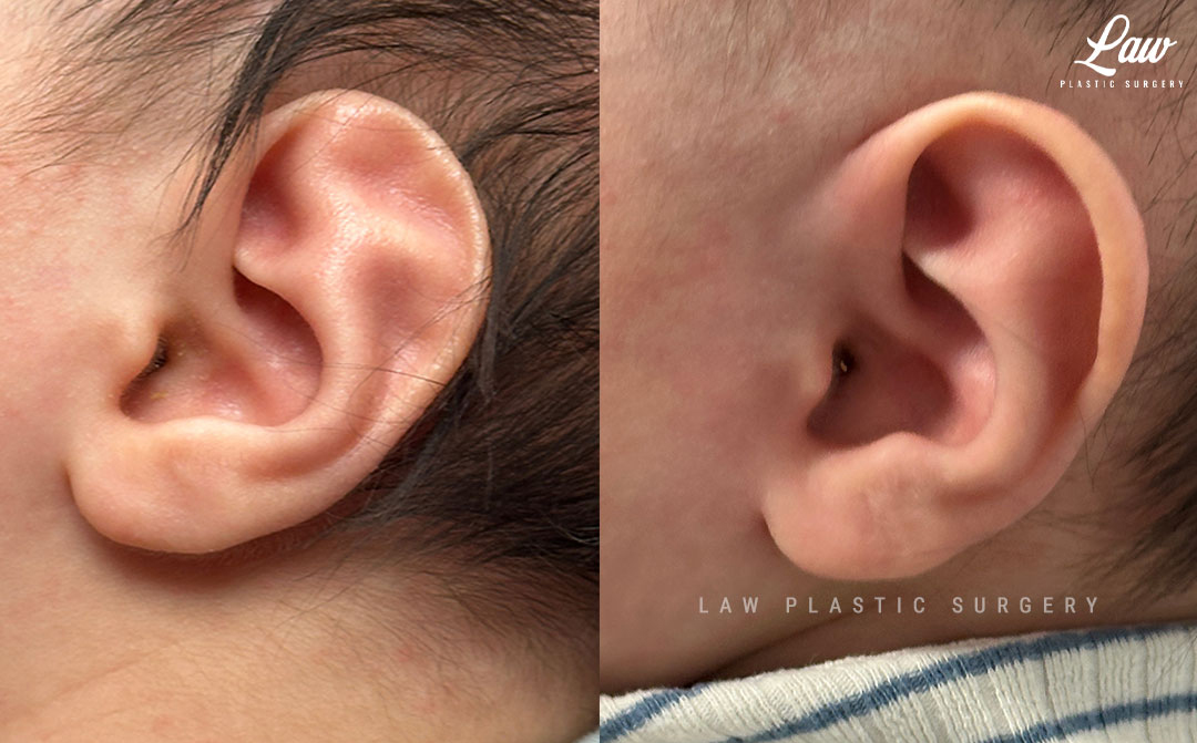Ear Molding Before and After Photo. Surgery performed in Dallas, TX at Law Plastic Surgery.