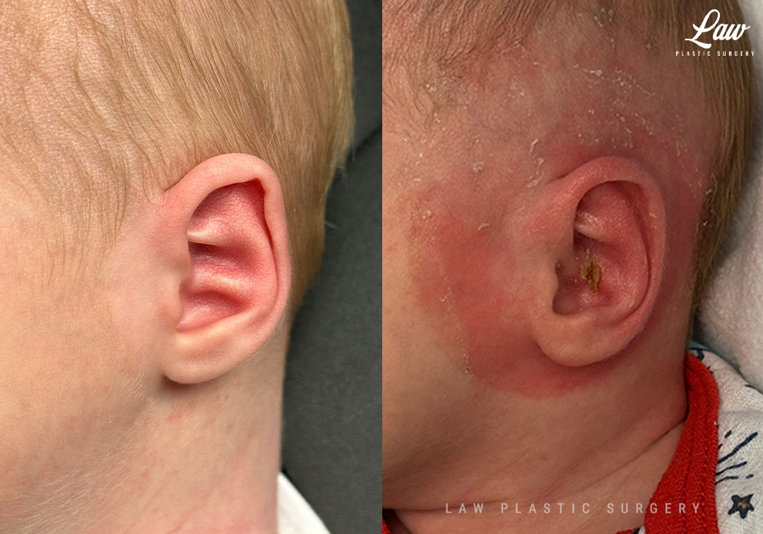 Ear Molding Before and After Photo. Surgery performed in Dallas, TX at Law Plastic Surgery.