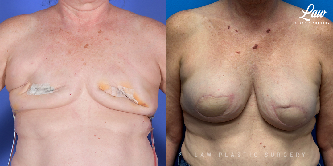 Breast Reconstruction Before and After Photo. Surgery performed in Dallas, TX at Law Plastic Surgery.