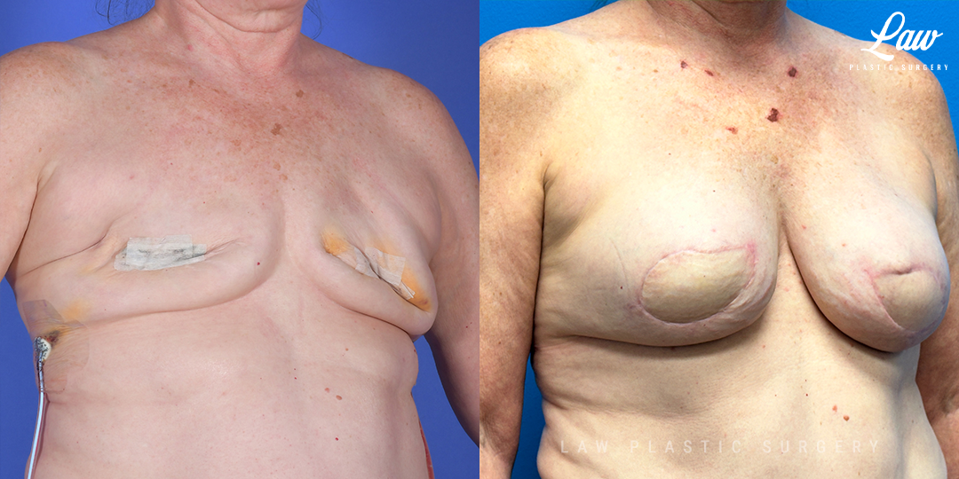 Breast Reconstruction Before and After Photo. Surgery performed in Dallas, TX at Law Plastic Surgery.