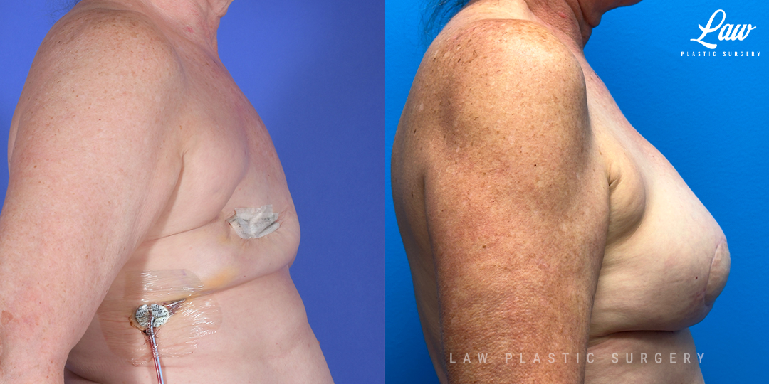 Breast Reconstruction Before and After Photo. Surgery performed in Dallas, TX at Law Plastic Surgery.