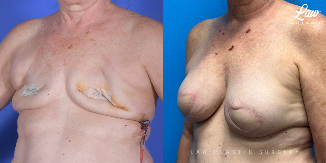 Breast Reconstruction Before and After Photo. Surgery performed in Dallas, TX at Law Plastic Surgery.