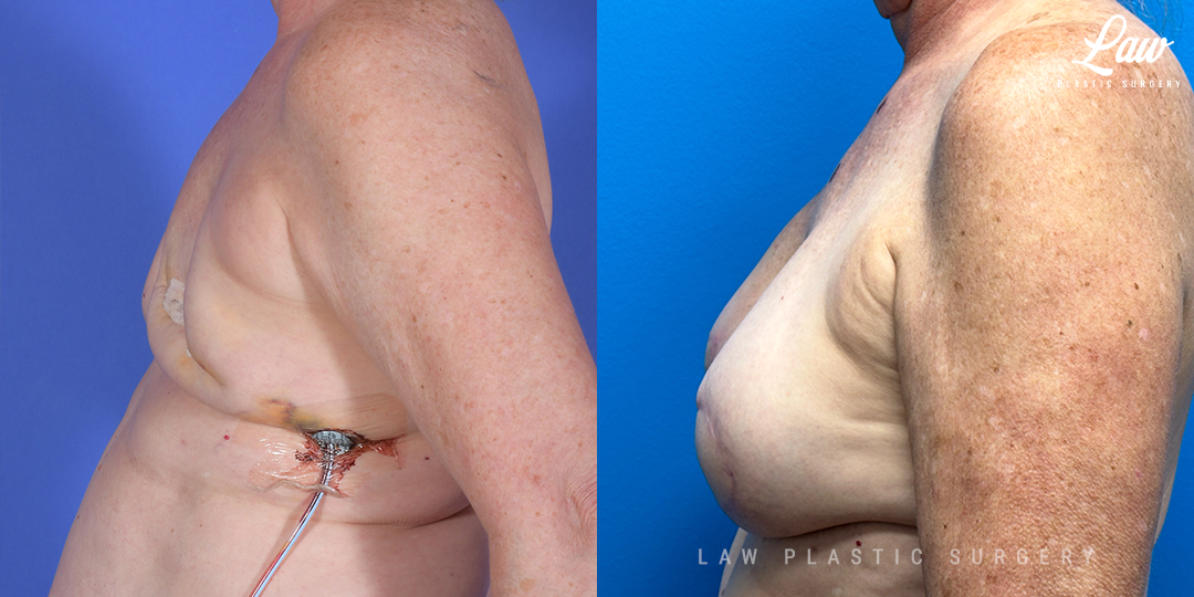 Breast Reconstruction Before and After Photo. Surgery performed in Dallas, TX at Law Plastic Surgery.