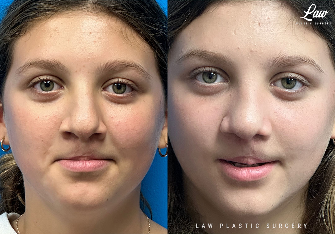 Cleft Rhinoplasty (Cleft Nose Surgery) Before & After Photo. Surgery performed in Dallas, TX at Law Plastic Surgery.