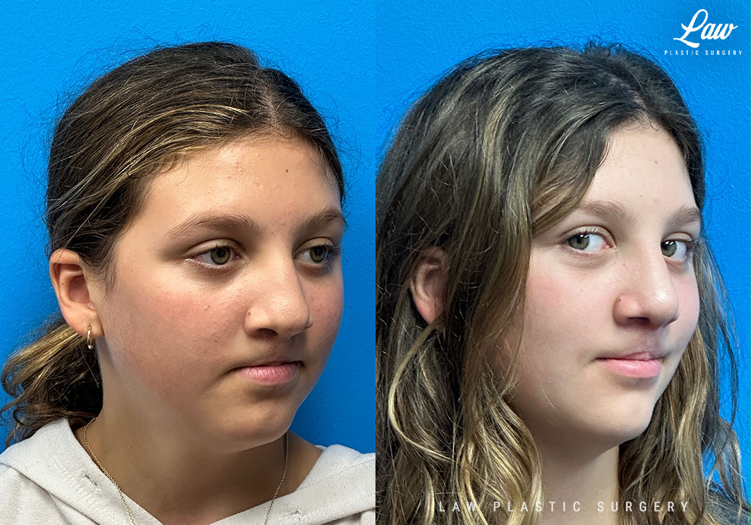 Cleft Rhinoplasty (Cleft Nose Surgery) Before & After Photo. Surgery performed in Dallas, TX at Law Plastic Surgery.