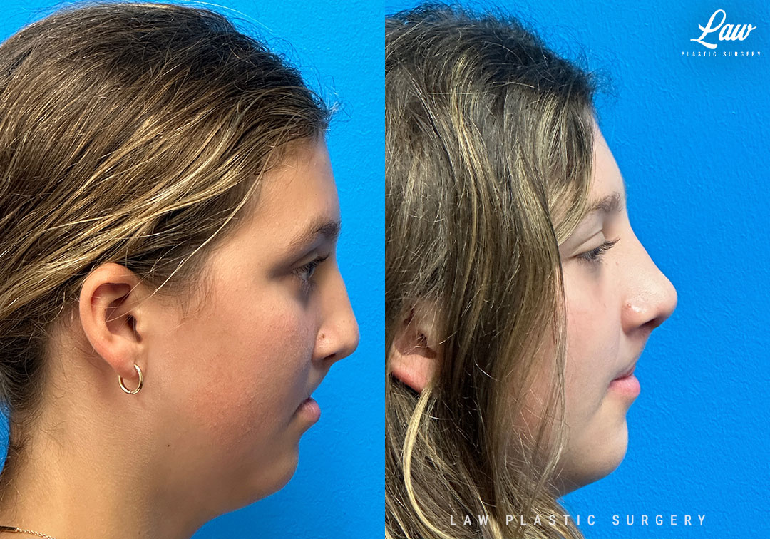 Cleft Rhinoplasty (Cleft Nose Surgery) Before & After Photo. Surgery performed in Dallas, TX at Law Plastic Surgery.