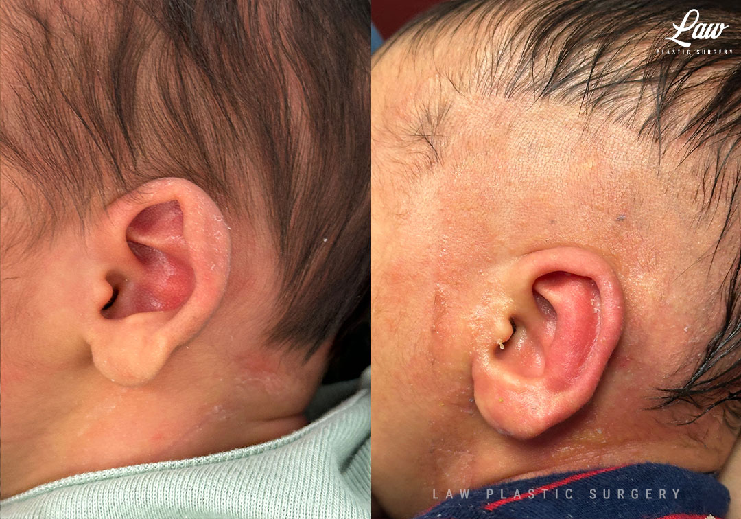 Ear Molding Before and After Photo. Surgery performed in Dallas, TX at Law Plastic Surgery.