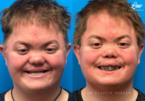 Jaw Surgery Before and After Photo. Surgery performed in Dallas, TX at Law Plastic Surgery.