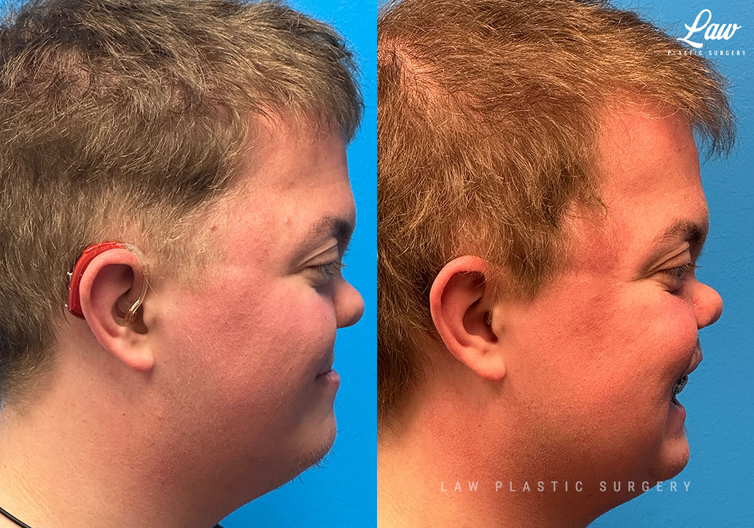 Jaw Surgery Before and After Photo. Surgery performed in Dallas, TX at Law Plastic Surgery.