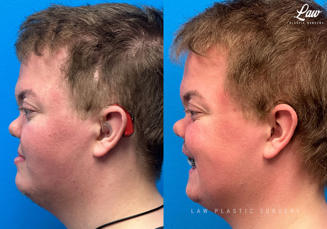 Jaw Surgery Before and After Photo. Surgery performed in Dallas, TX at Law Plastic Surgery.