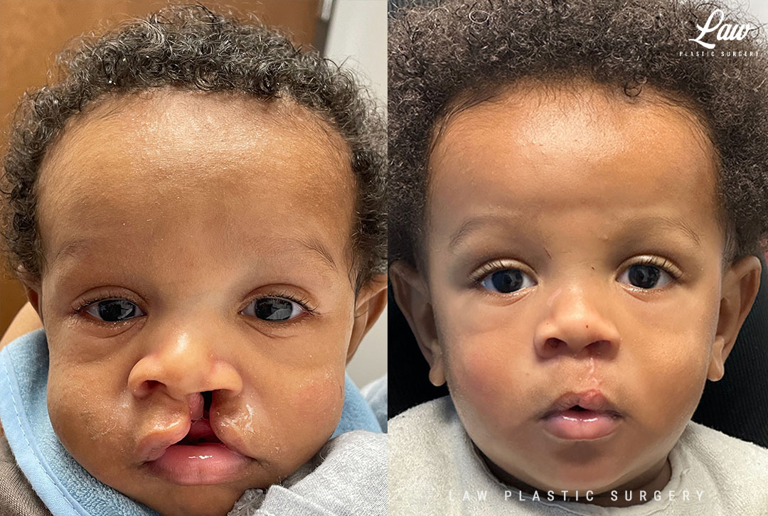 Cleft Lip Repair Before & After Photo. Surgery performed in Dallas, TX at Law Plastic Surgery.