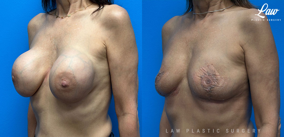 Breast Implant Removal (Breast Explant) Before & After Photo. Surgery performed in Dallas, TX at Law Plastic Surgery.