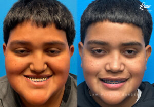 Jaw Surgery Before and After Photo. Surgery performed in Dallas, TX at Law Plastic Surgery.