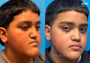 Jaw Surgery Before and After Photo. Surgery performed in Dallas, TX at Law Plastic Surgery.