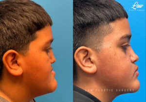 Jaw Surgery Before and After Photo. Surgery performed in Dallas, TX at Law Plastic Surgery.