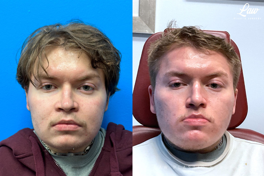 Jaw Surgery Before and After Photo. Surgery performed in Dallas, TX at Law Plastic Surgery.