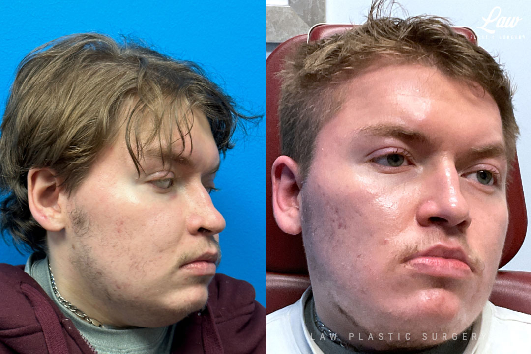 Jaw Surgery Before and After Photo. Surgery performed in Dallas, TX at Law Plastic Surgery.