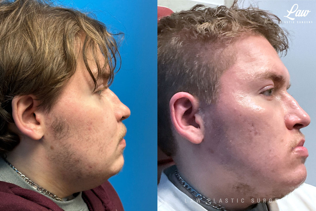 Jaw Surgery Before and After Photo. Surgery performed in Dallas, TX at Law Plastic Surgery.