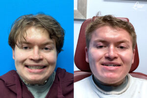 Jaw Surgery Before and After Photo. Surgery performed in Dallas, TX at Law Plastic Surgery.